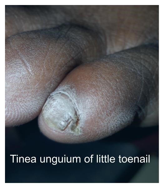 Diagnosis and Management of Onychomycosis (Tinea Unguium) with Pictorial  details