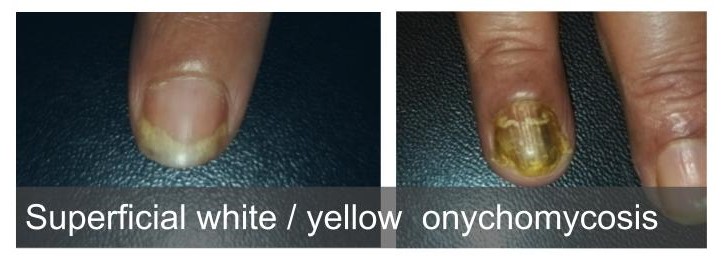 Elmicrobiologist - 👉 Onychomycosis (tinea unguium) Onychomycosis